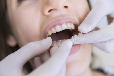 Que faut-il savoir sur l'orthodontie par gouttières ?